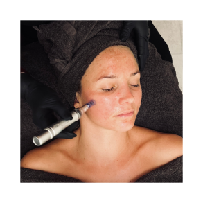 SkinPen - Ansigt, hals & bryst