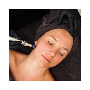 SkinPen - Ansigt & hals